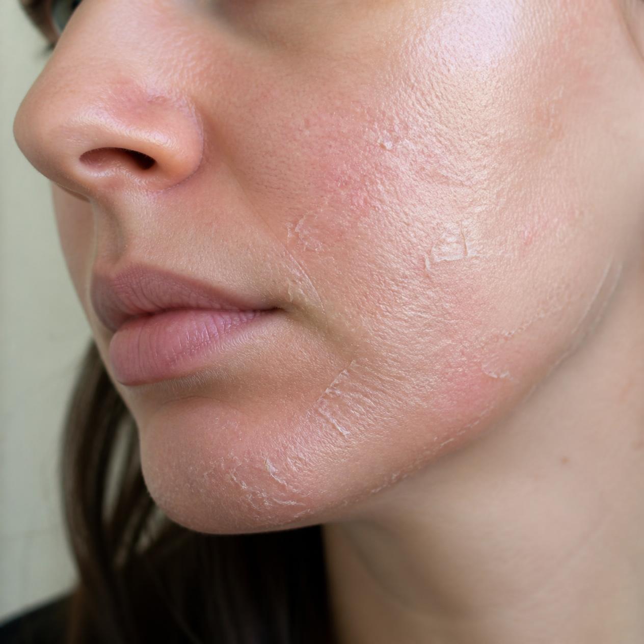 Why Tretinoin Doesn’t Work for Some People & What to Try Instead