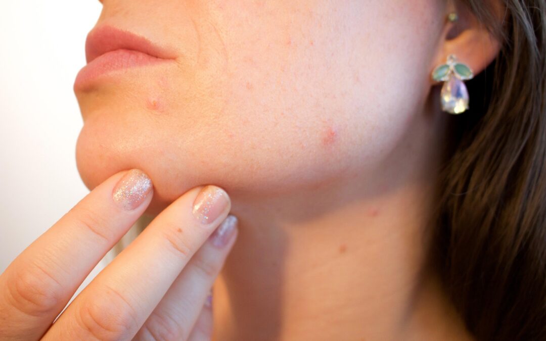Azelaic Acid: The Underrated Skincare Ingredient That Deserves More Attention